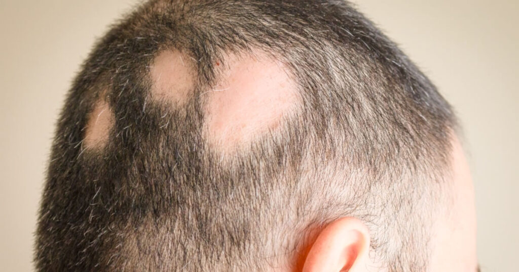 Alopecia areata