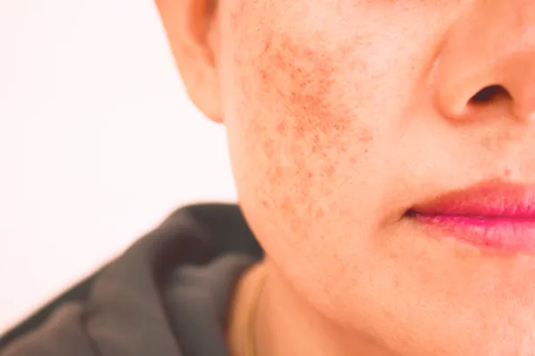 Melasma, mancha hormonal en la piel