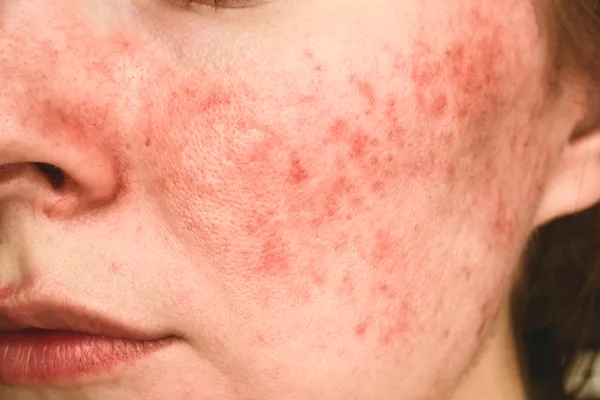 Manchas rojas en la piel. Rosacea.