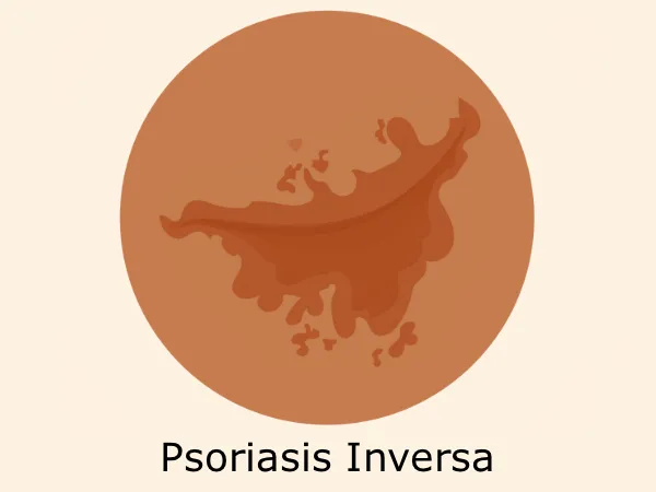 pasoriasis-inversa