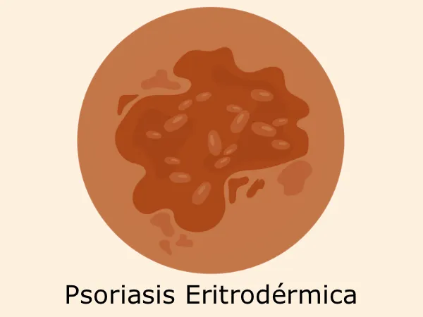 psoriasis-eritrodermica