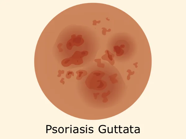 psoriasis-guttata