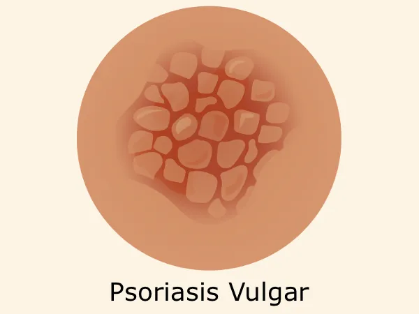 Psoriasis Vulgar